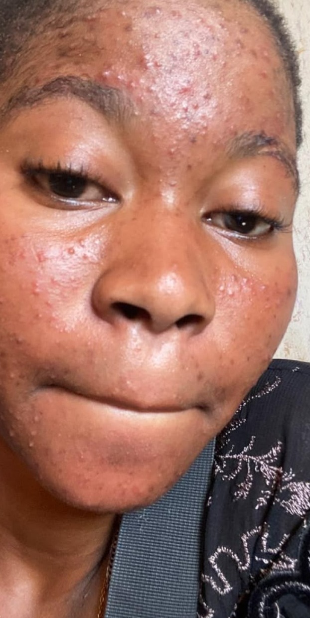 Avant les soins BIOCARE — Bintou W., Gamme Hyperpigmentation — 10 semaines