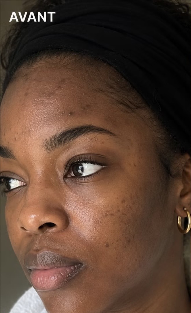 Avant les soins BIOCARE — Awa N., Crème visage — 6 semaines